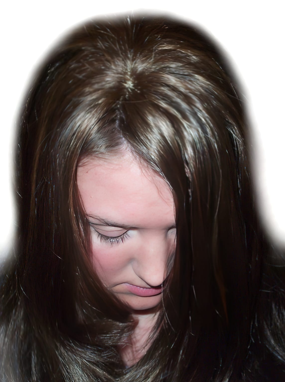 After Picture - Trichotillomania